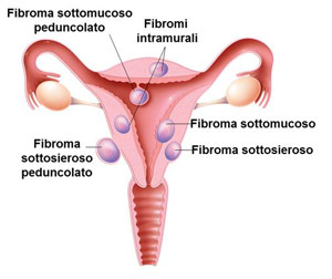 Il fibroma uterino